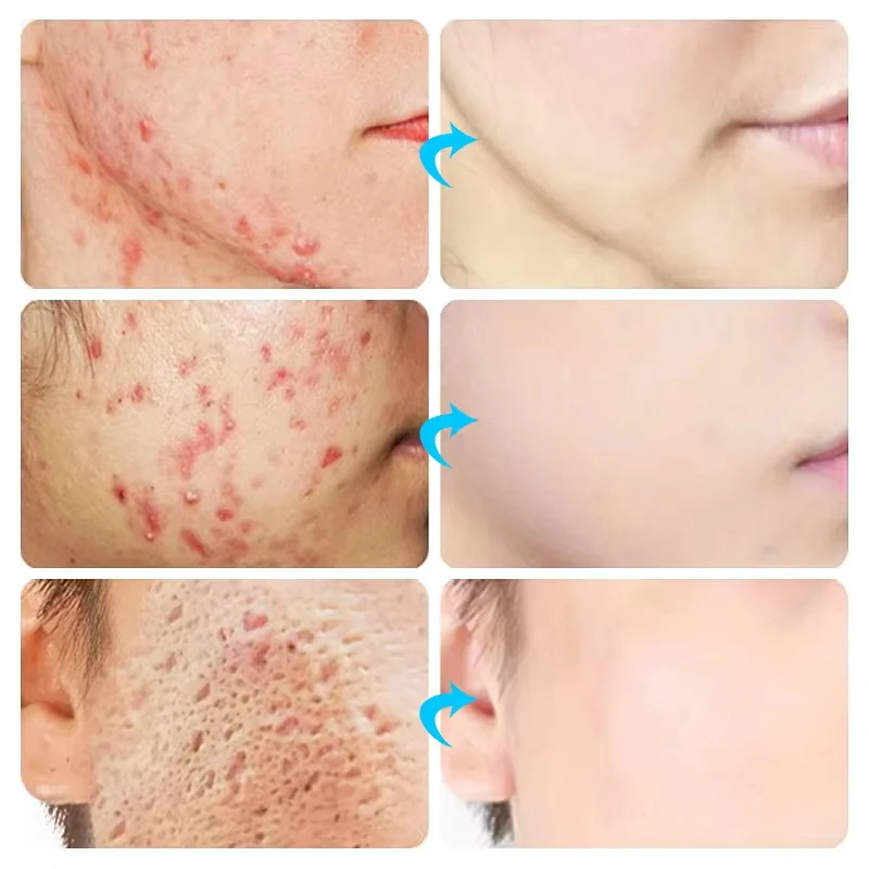 Crema para el acné para el ros - Korean Skincare Routine reseña y precio