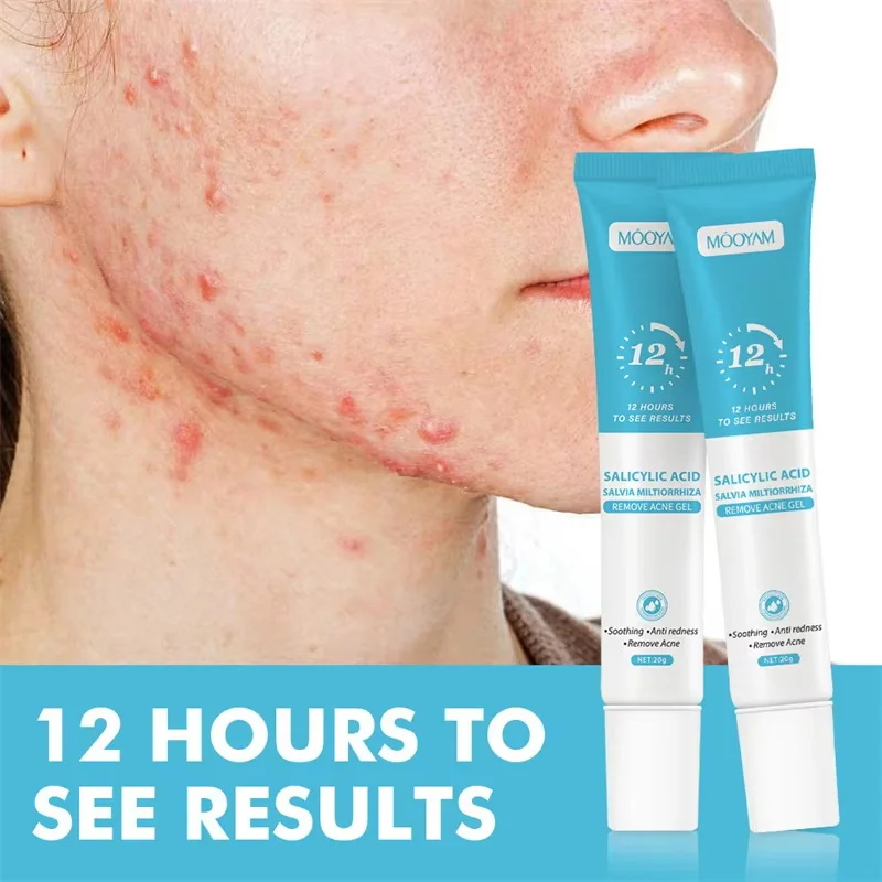 Crema para el acné para el ros - Korean Skincare Routine reseña y precio