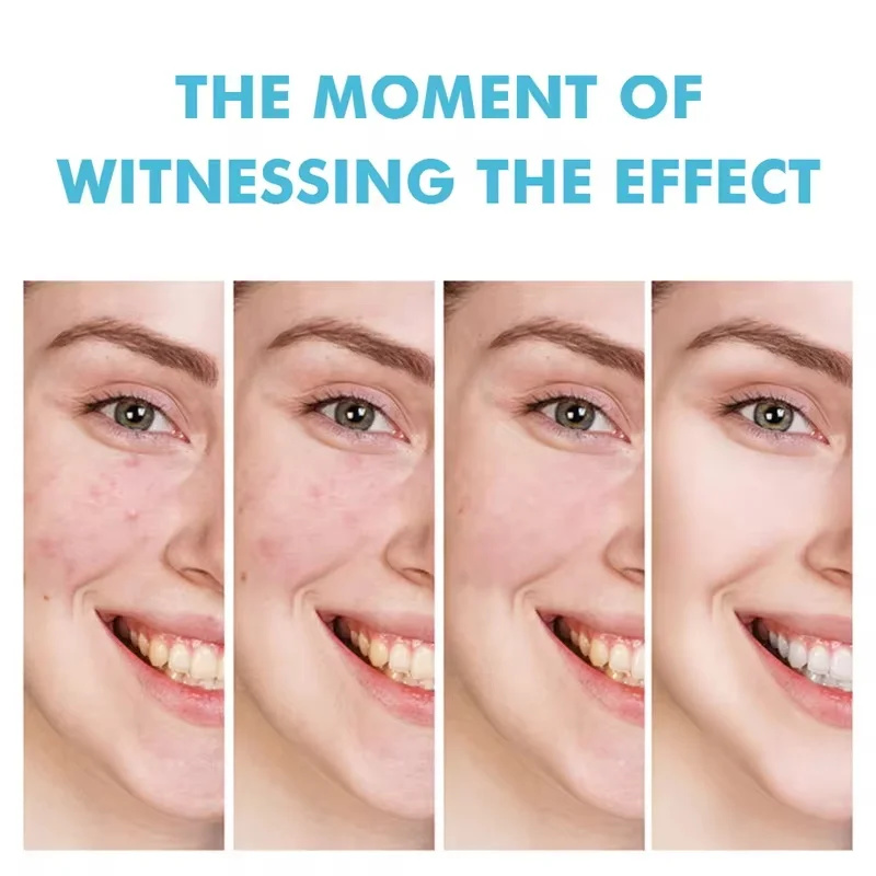 Crema para el acné para el ros - Korean Skincare Routine reseña y precio